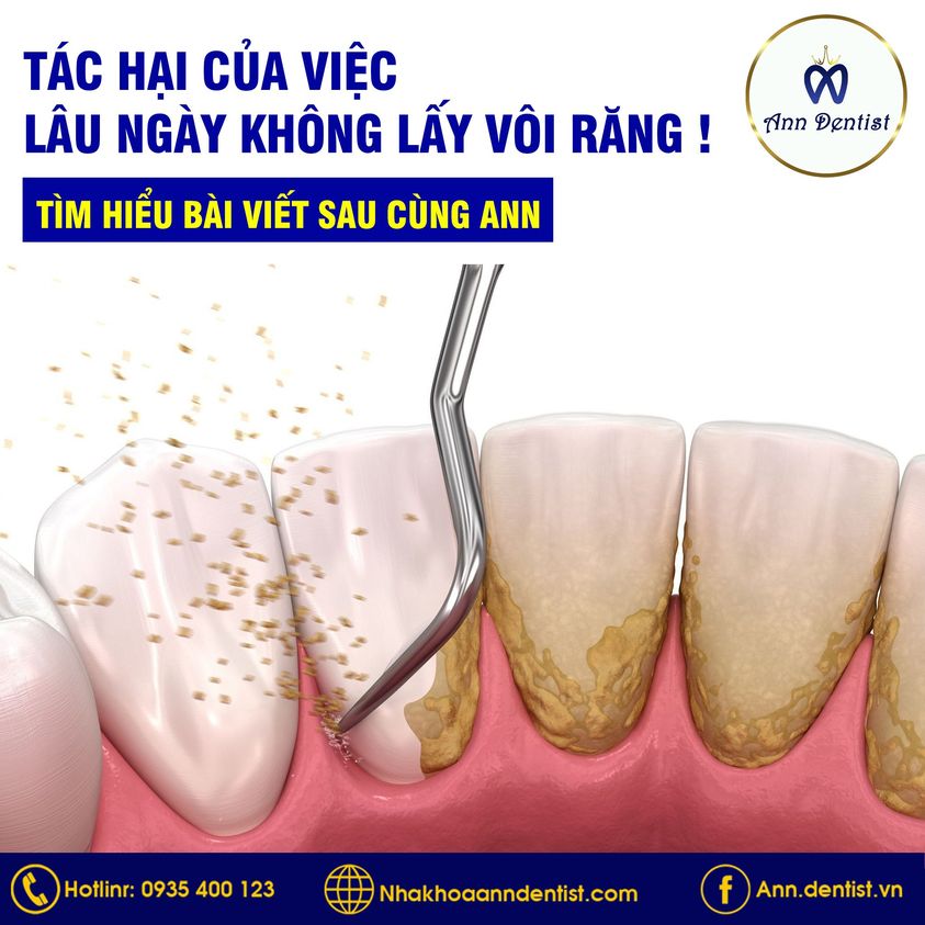 Tác hại của việc lâu ngày không lấy vôi răng