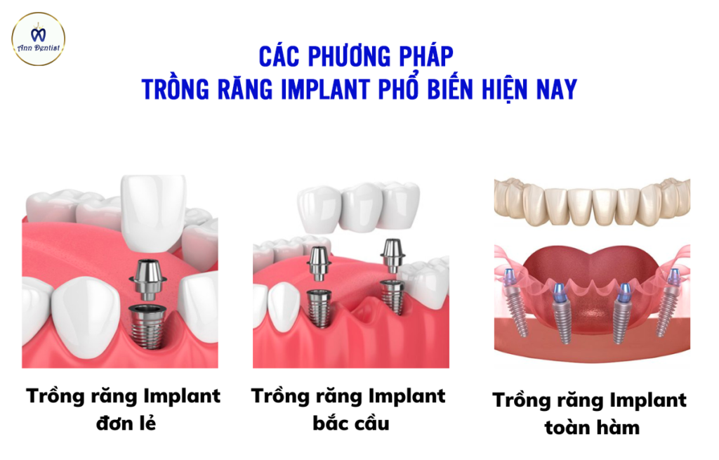 Các phương pháp trồng răng implant phổ biến hiện nay.