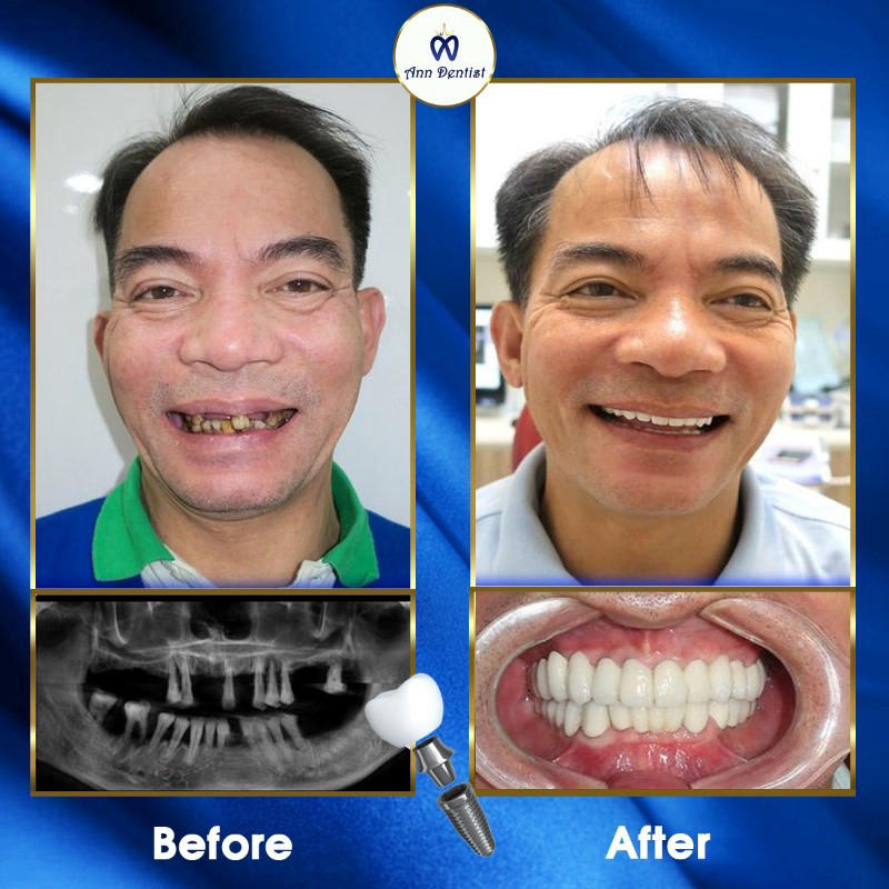 Thay đổi khách hàng sau khi trồng răng Implant tại Ann Dentist