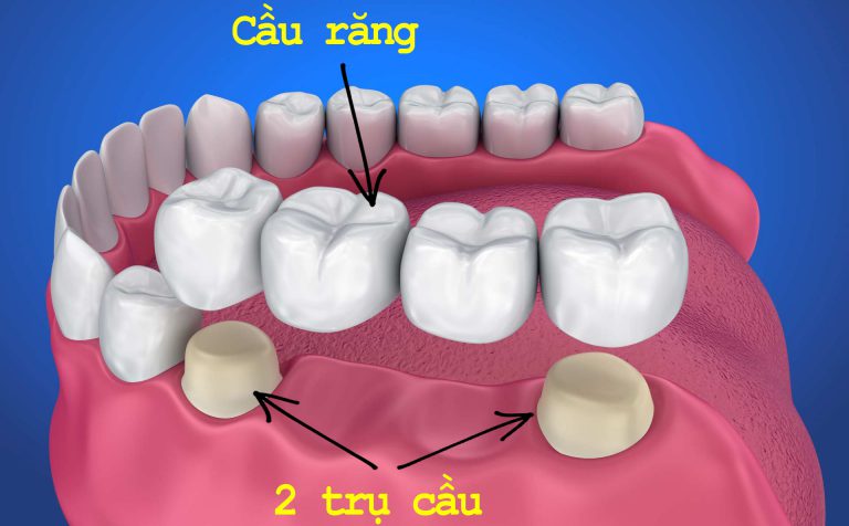 Cầu răng sứ trong trường hợp mất 2 răng liền kề.