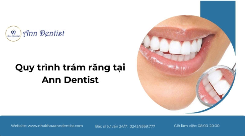 Quy trình trám răng tại Ann Dentist