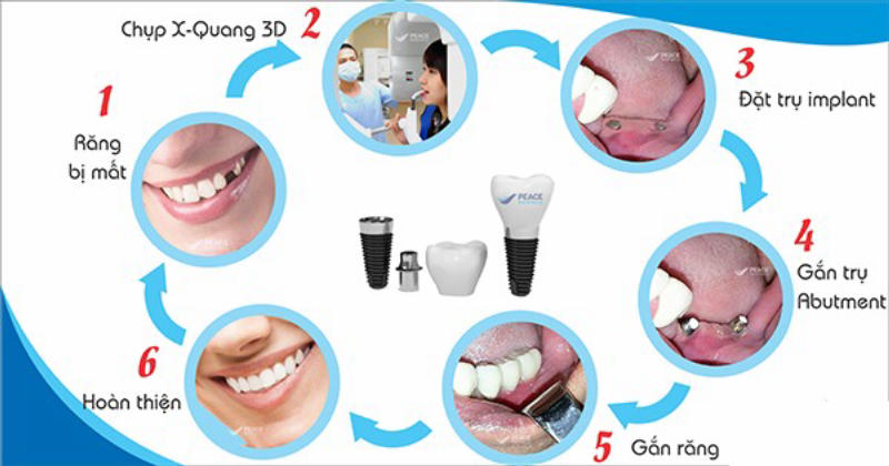 Quy trình trồng răng Implant 6 bước chuẩn y khoa tại Ann Dentist