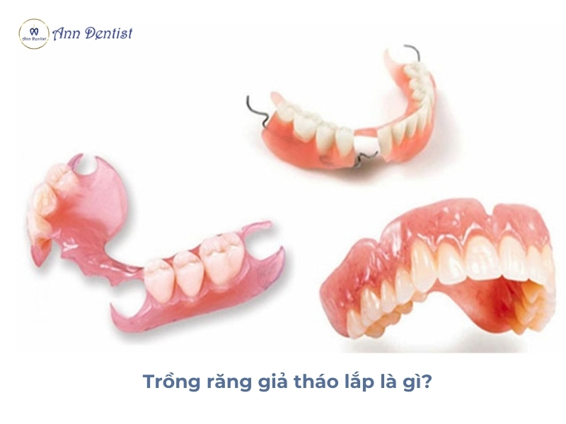 Trồng răng giả tháo lắp là gì?