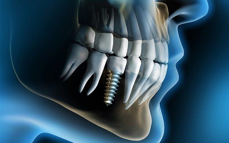 Trồng răng implant thay thế răng mất hoàn hảo.
