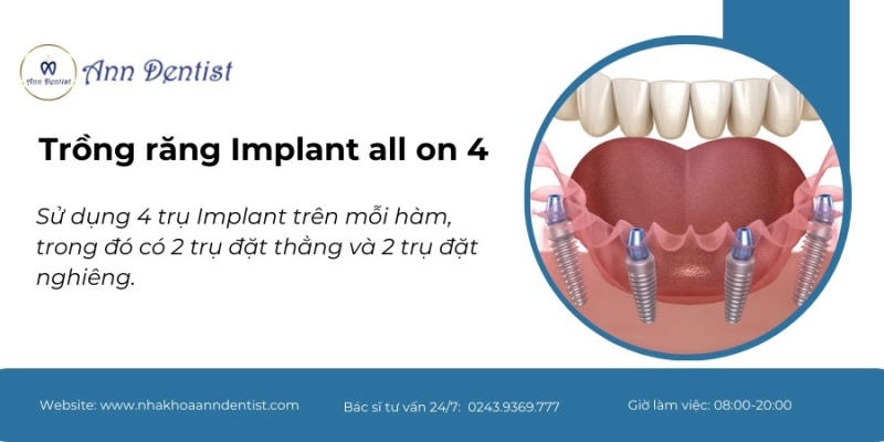 Trồng răng Implant all on 4