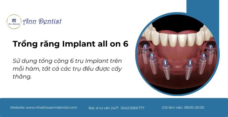 Trồng răng Implant all on 6