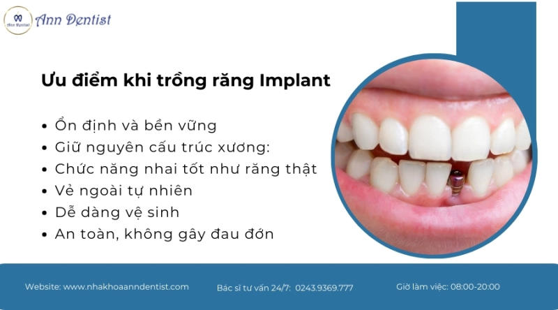 Đánh giá ưu điểm của phương án trồng răng Implant