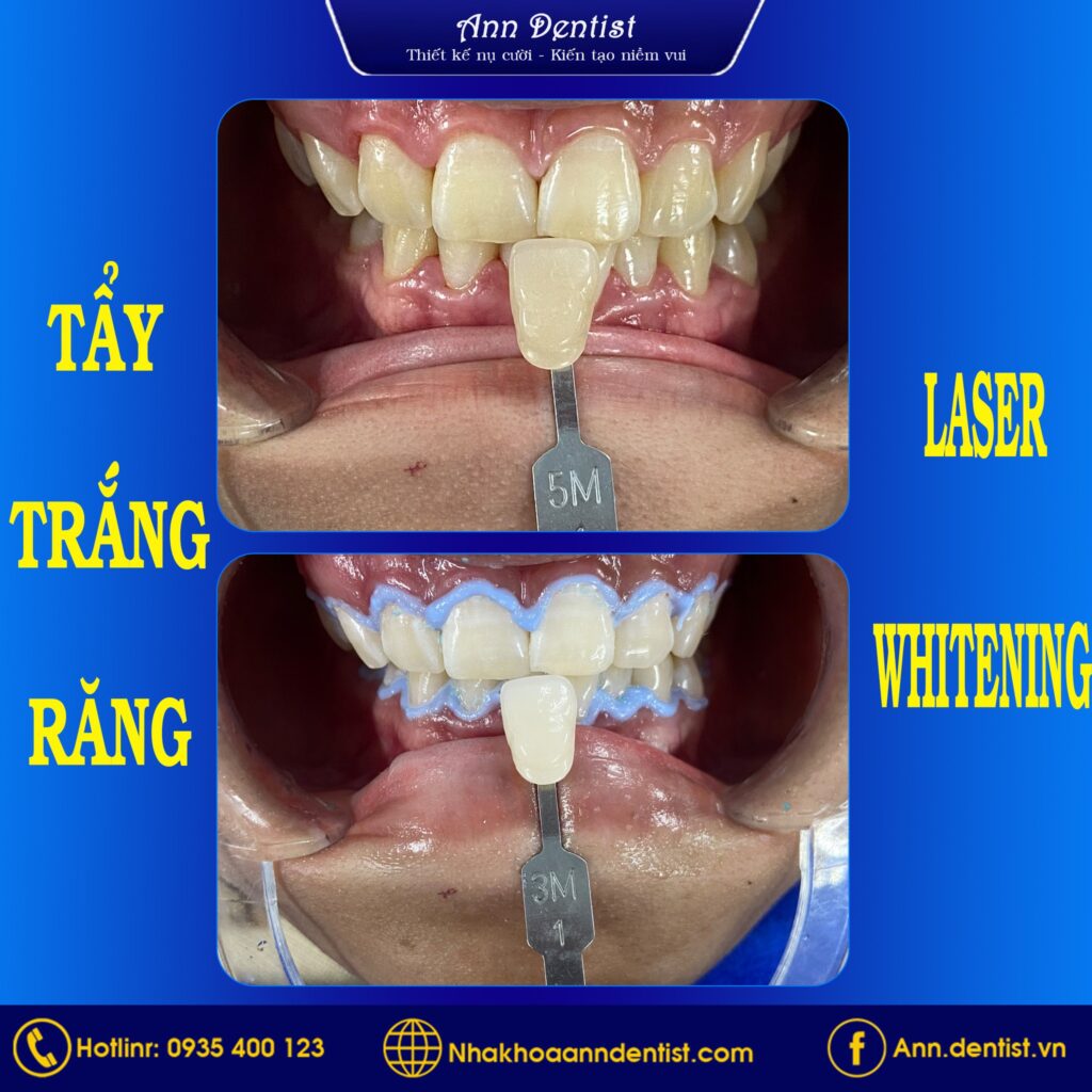 Hình ảnh trước và sau của khách hàng sau khi sử dụng công nghệ tẩy trắng răng Laser Whitening tại Ann Dentist.