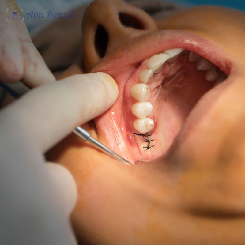 Trồng răng implant có đau không? Câu trả lời là có đau