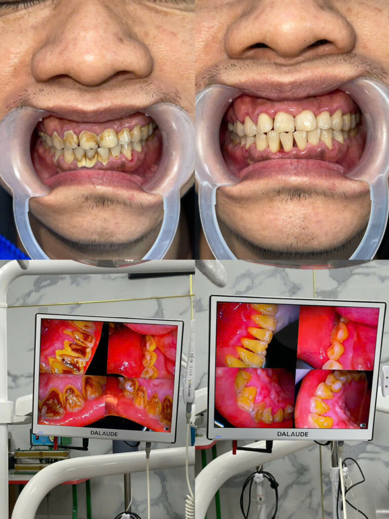 Hình ảnh khách hàng trước và sau khi sử dụng dịch vụ Cạo vôi răng tại Ann Dentist