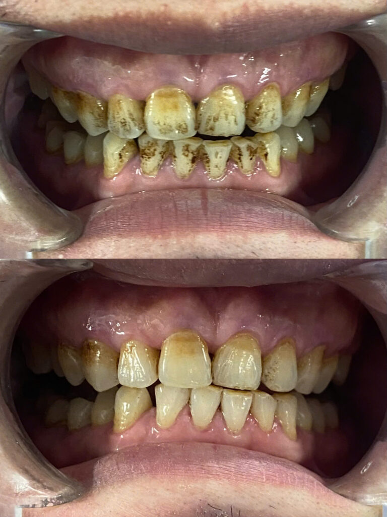 Hình ảnh khách hàng trước và sau khi sử dụng dịch vụ Cạo vôi răng tại Ann Dentist