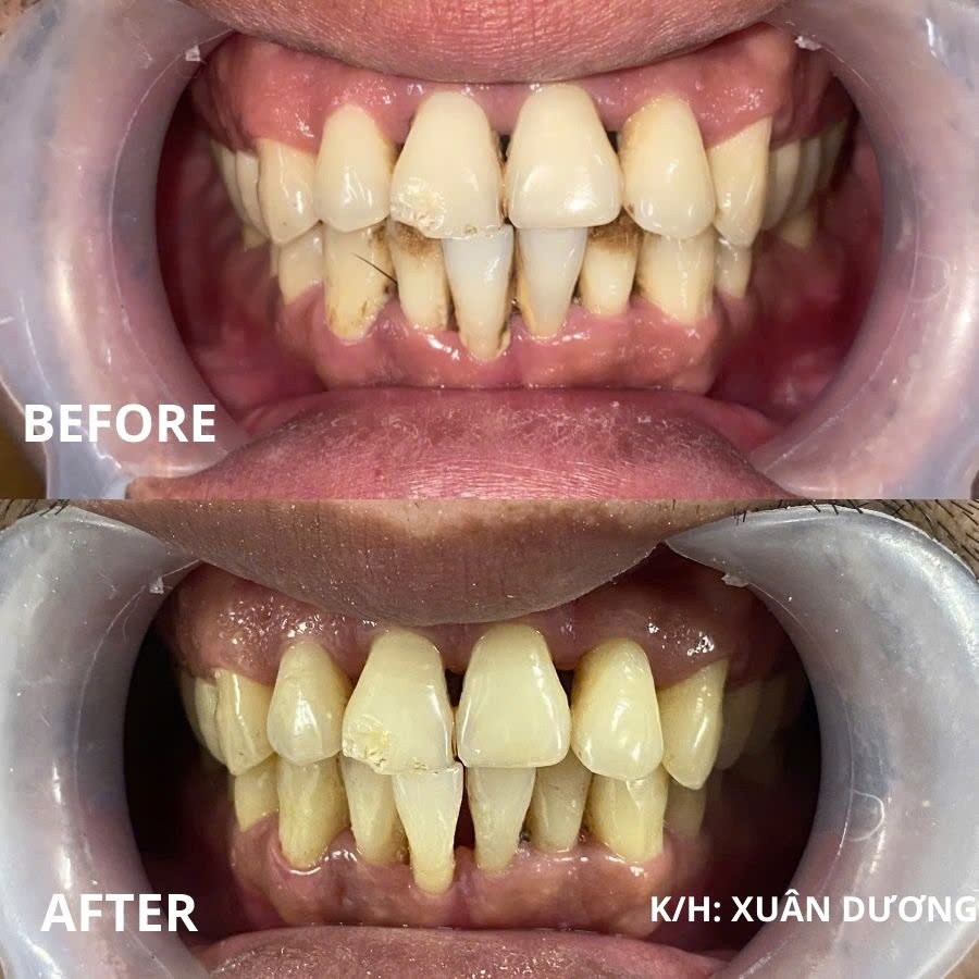 Hình ảnh khách hàng trước và sau khi sử dụng dịch vụ Cạo vôi răng tại Ann Dentist