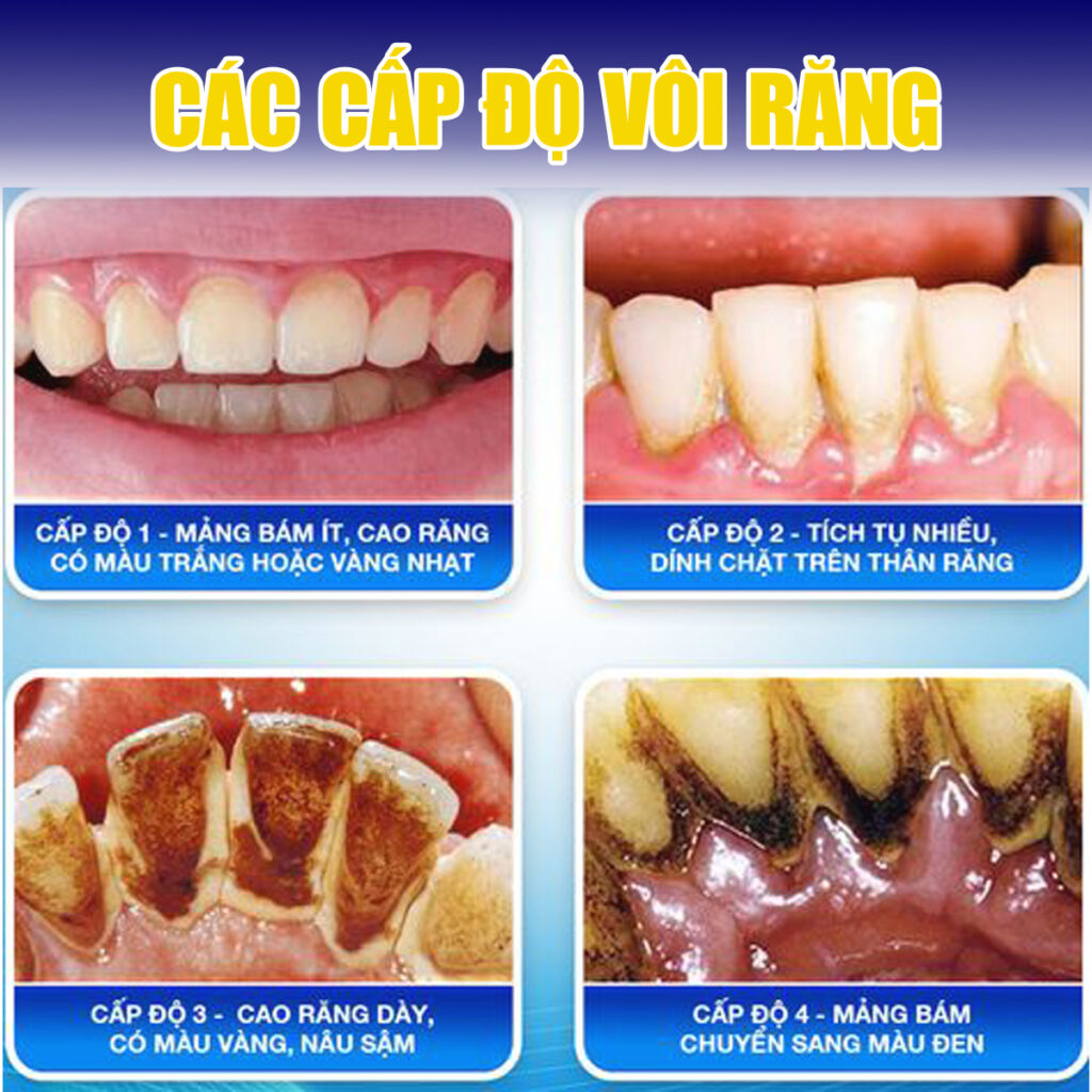 Các cấp độ của vôi răng