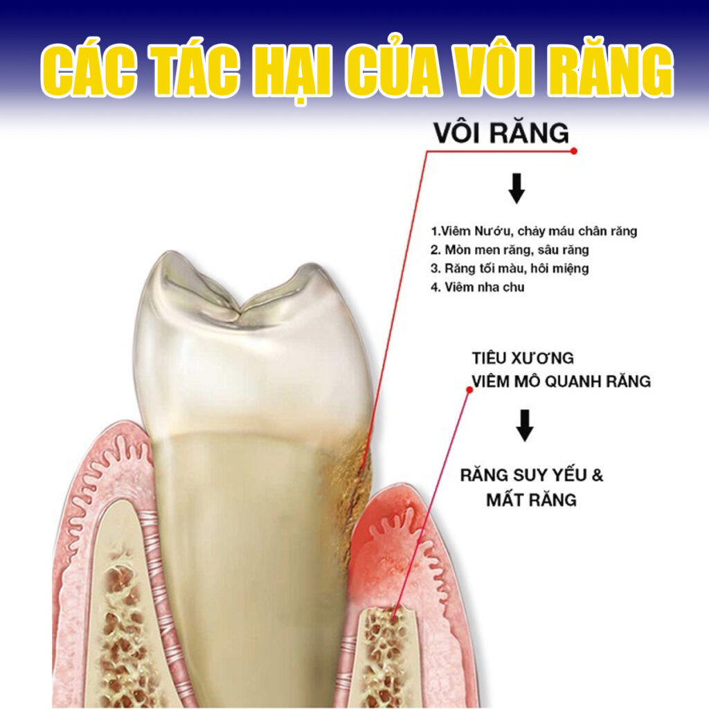 Tác hại của việc không lấy vôi răng