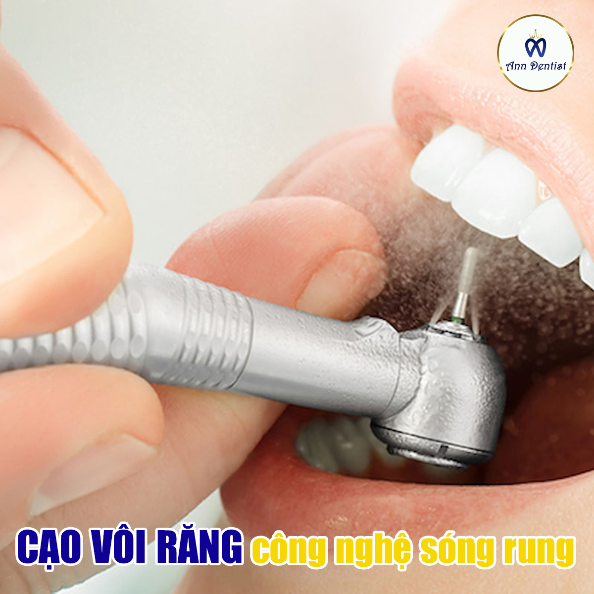 Cạo vôi răng bằng sóng rung siêu âm