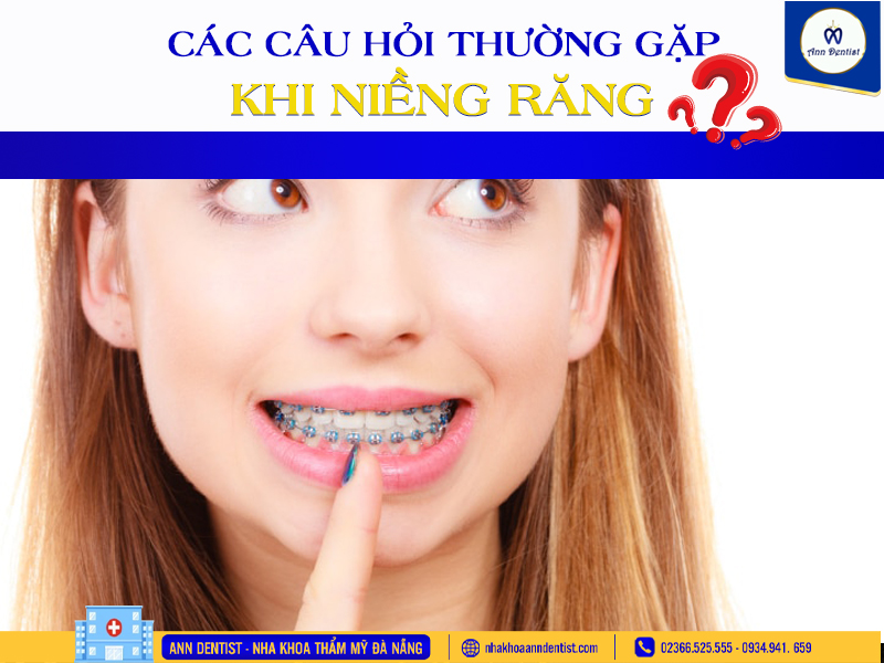 Các câu hỏi thường gặp khi niềng răng?