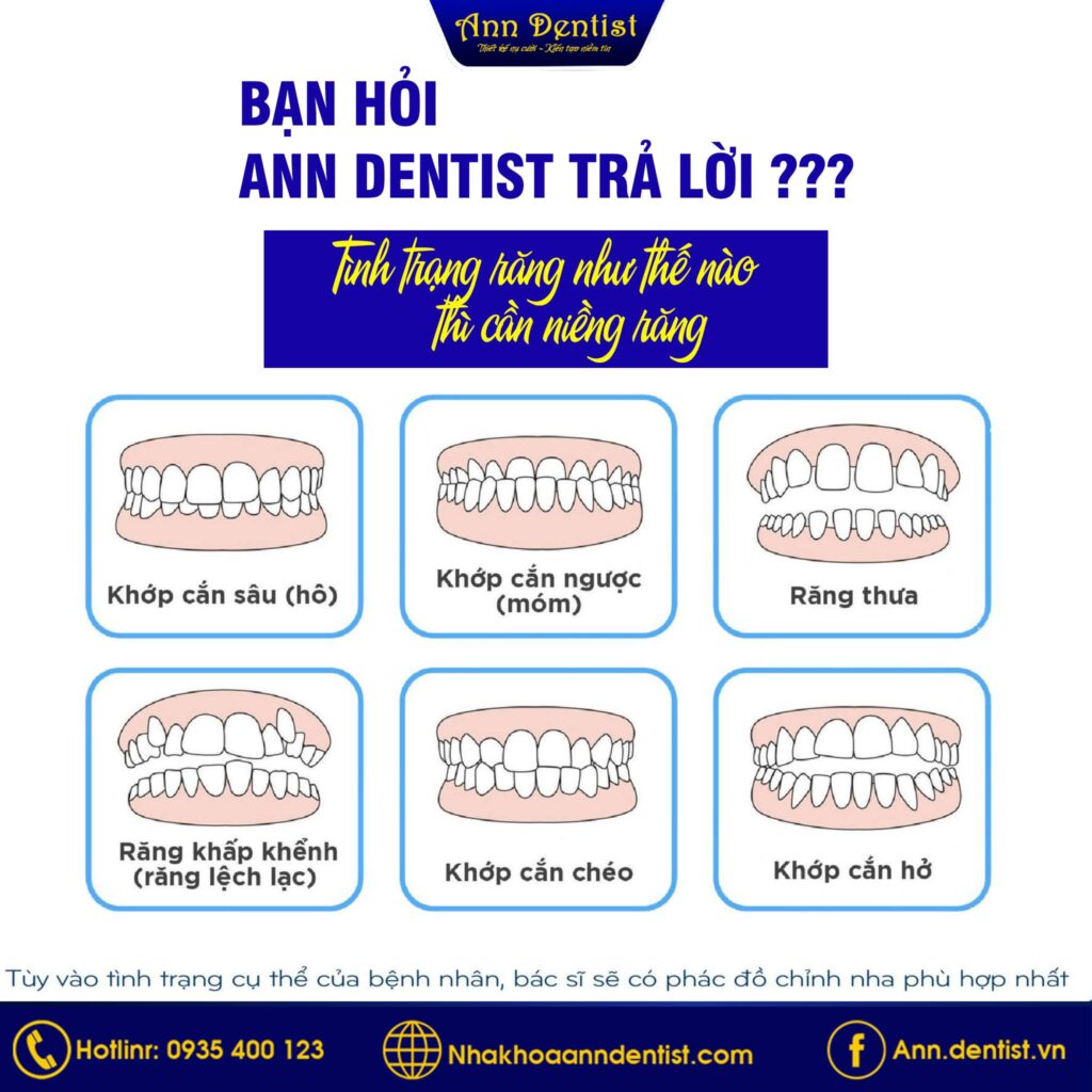 Các trường hợp nên niềng răng