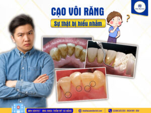 Cạo vôi răng bạn đã hiểu đúng chưa?