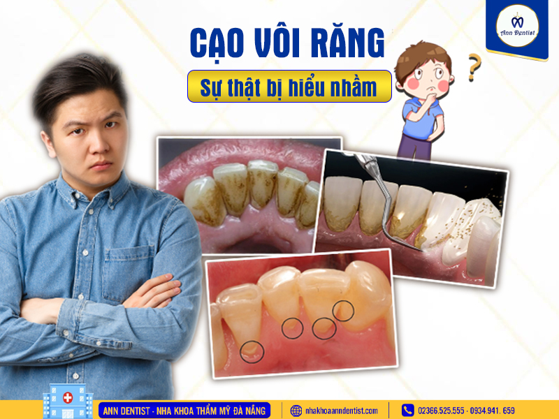 Cạo vôi răng bạn đã hiểu đúng chưa?