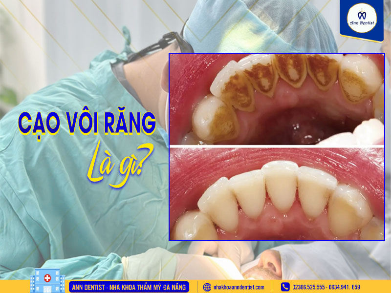 Cạo vôi răng là gì?