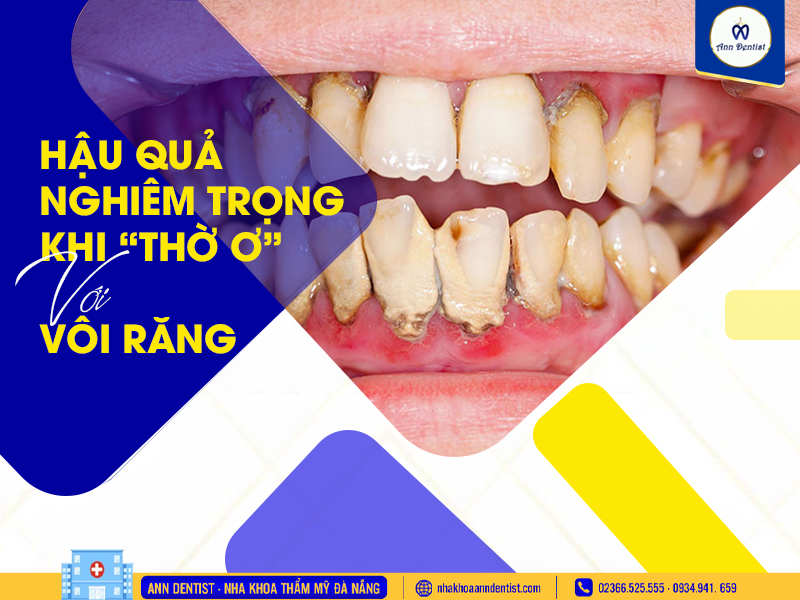 Hậu quả nghiêm trọng khi thơ ơ với vôi răng.