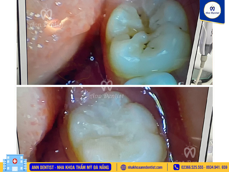 Hình ảnh khách hàng trước và sau khi trám răng tại Ann Dentist.