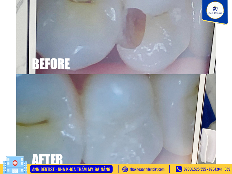 Hình ảnh khách hàng trước và sau khi trám răng tại Ann Dentist.