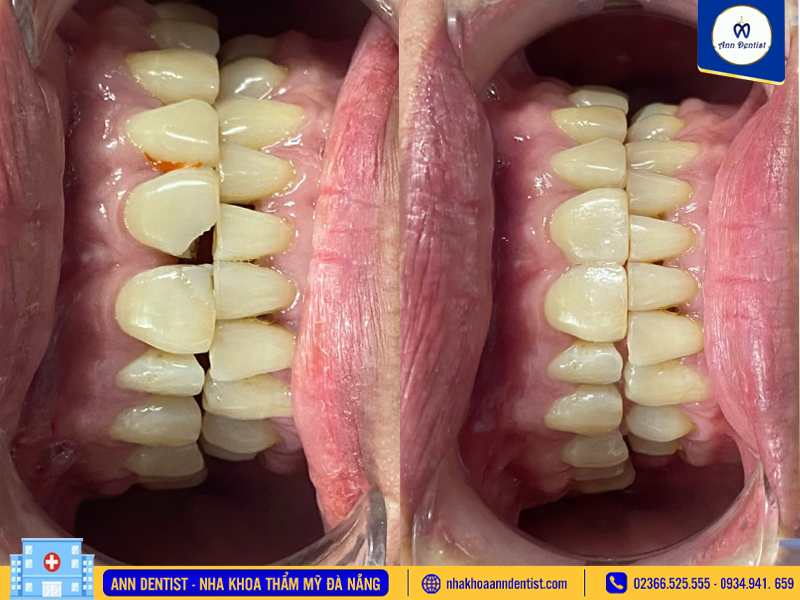 Hình ảnh khách hàng trước và sau khi trám răng tại Ann Dentist.