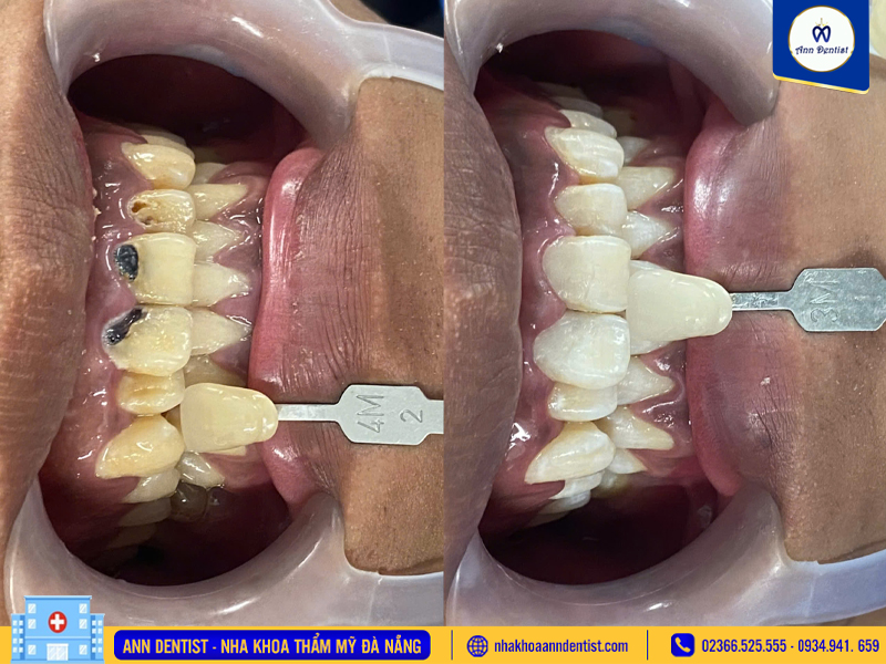 Hình ảnh khách hàng trước và sau khi trám răng tại Ann Dentist.