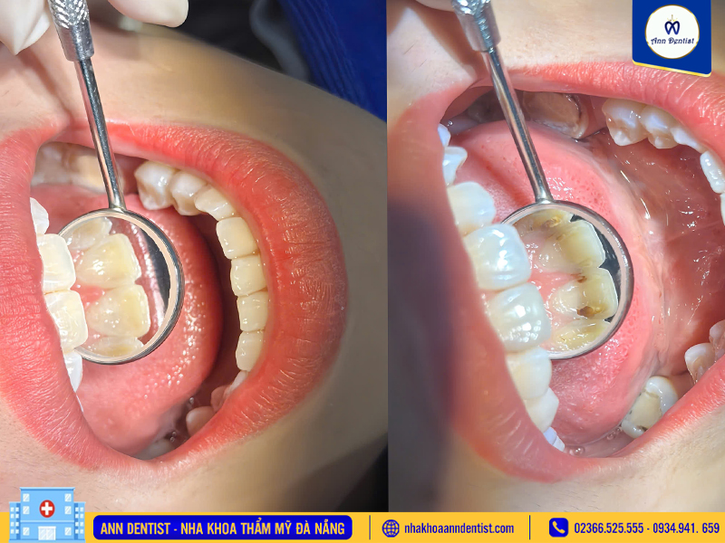 Hình ảnh khách hàng trước và sau khi trám răng tại Ann Dentist.