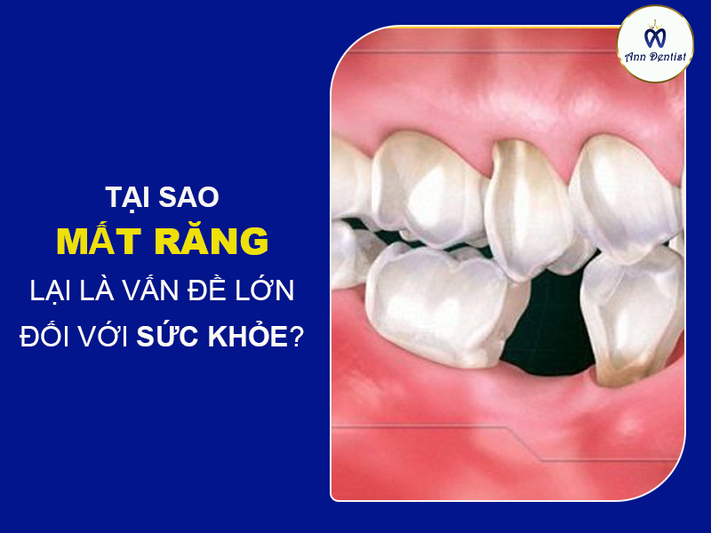 Mất răng ảnh hưởng rất lớn đến sức khỏe răng miệng - Ann Dentist