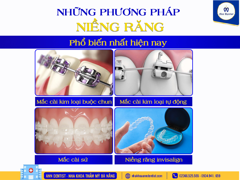 Những phương pháp niềng răng phổ biến hiện nay.