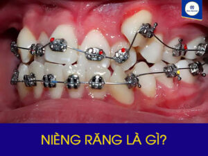 Niềng răng la gì?