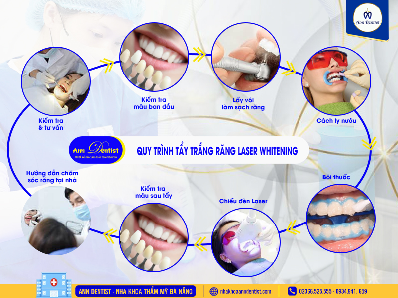Quy trình tẩy trắng răng tại Ann Dentist.