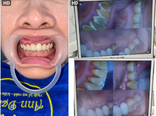 Hình ảnh trước và sau khi lấy vôi răng ở Ann Dentist.