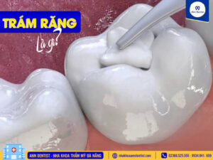 Trám răng là gì?