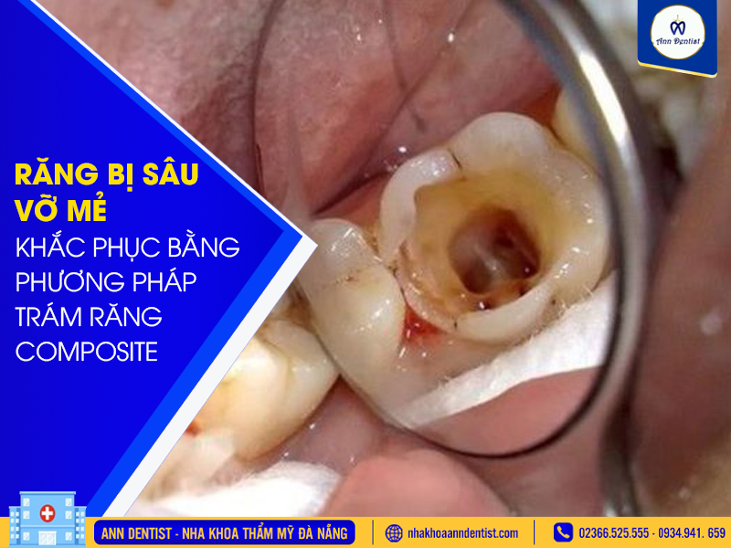 Trám răng khi răng bị sâu, mẻ vỡ.