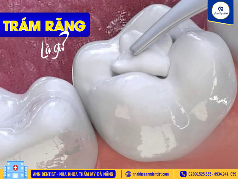 Trám răng là gì?