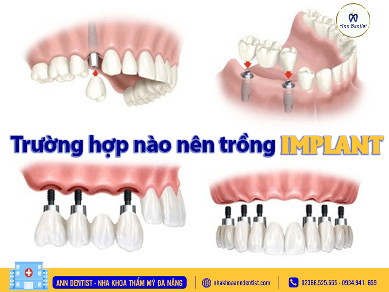 Trường hợp nào nên trồng răng implant - Ann Dentist.