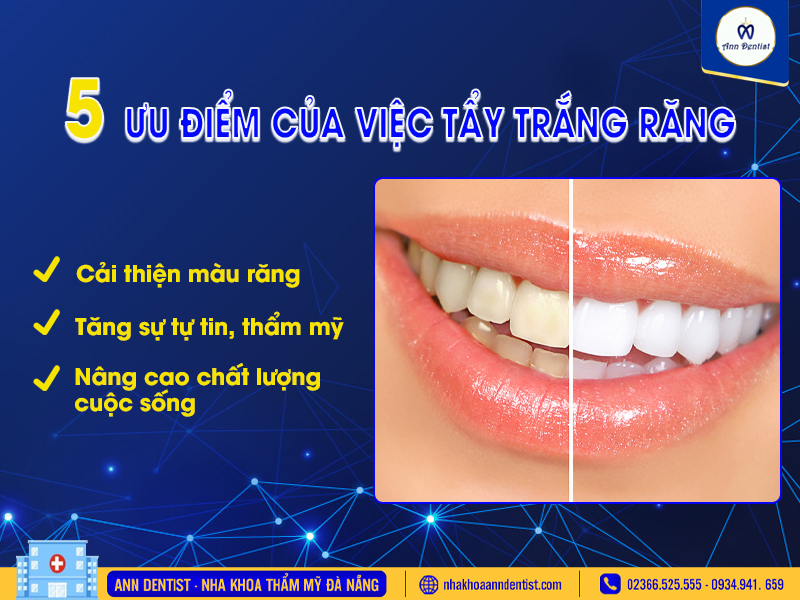 Ưu điểm của việc tẩy trắng răng.