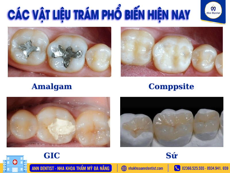 Vật liệu trám phổ biến hiện nay.