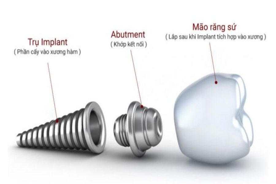 Cấu tạo trụ implant hoàn chỉnh - Ann Dentist