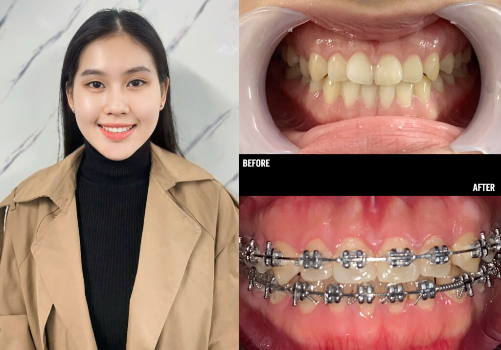 Hình ảnh khách hàng sau khi niềng răng tại Ann Dentist.