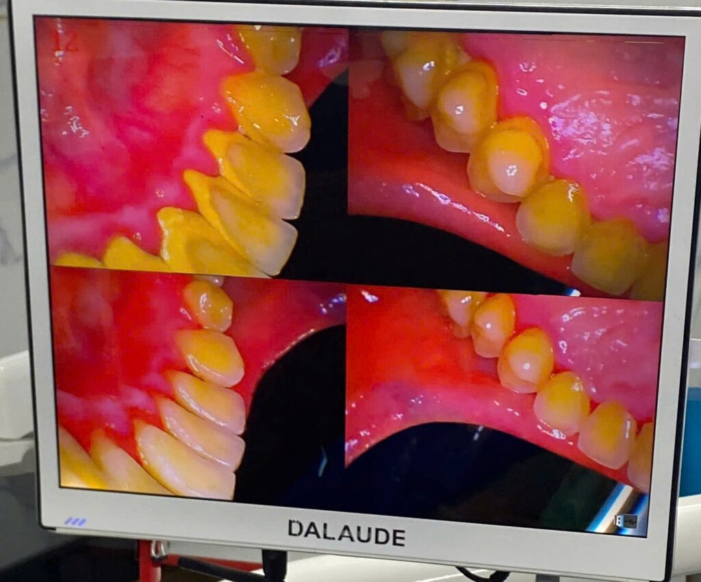 Hình ảnh trước và sau khi lấy vôi răng ở Ann Dentist.