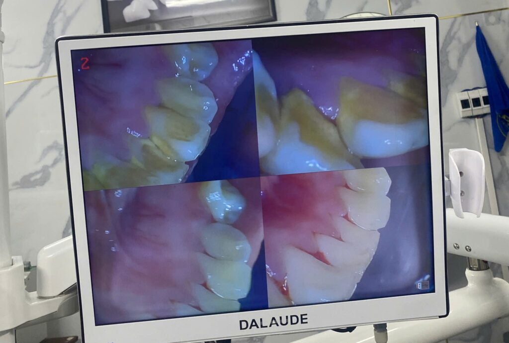 Hình ảnh trước và sau khi lấy vôi răng ở Ann Dentist.