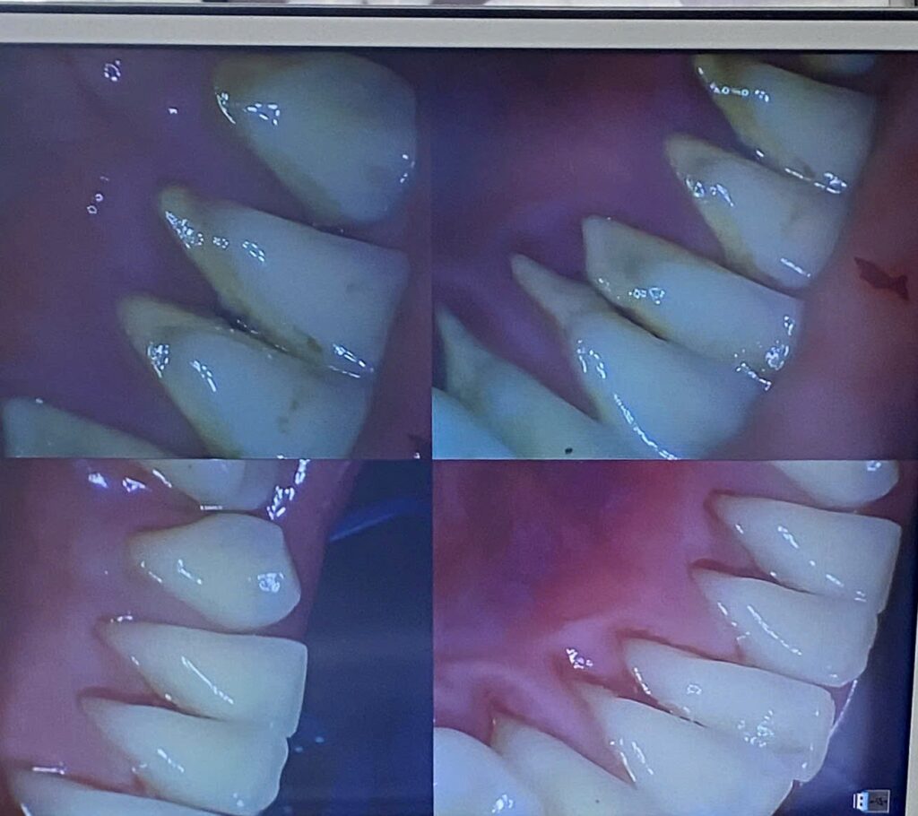 Hình ảnh trước và sau khi lấy vôi răng ở Ann Dentist.