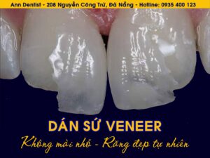 Dán sứ mài ít hoặc không mài giúp cải thiện nụ cười tự nhiên, không đau, bảo tồn răng thật. Tìm hiểu chi tiết quy trình & giá tại Ann Dentist!