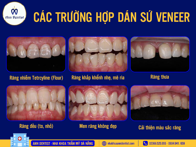 Các trường hợp dán sứ Veneer.