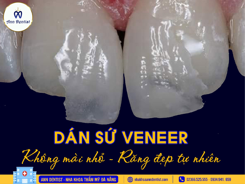 Dán sứ Laminate công nghệ dán sứ tiên tiến không xâm lấn mô răng.