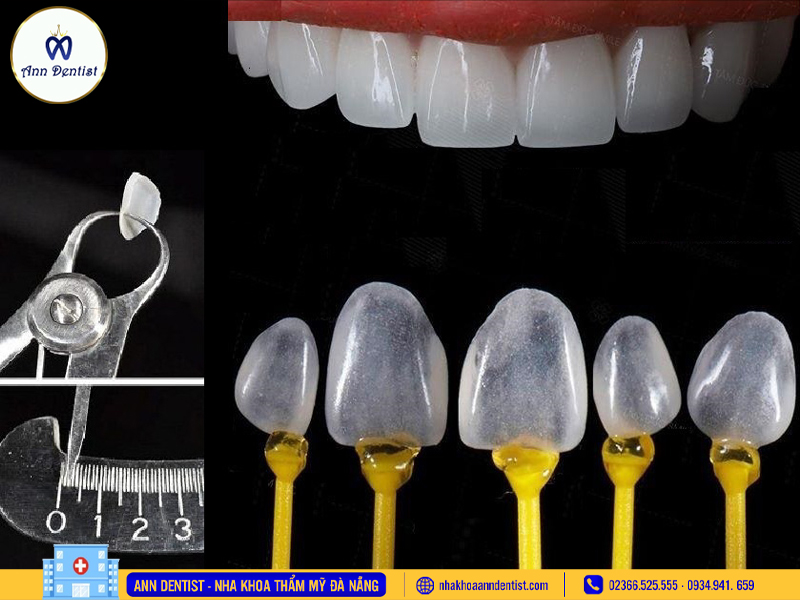 Dán sứ Veneer mài chỉ 0,2mm.